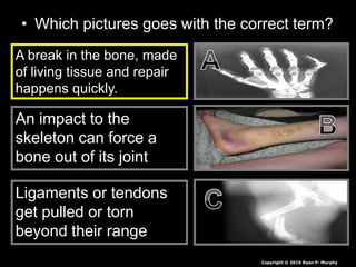 • Which pictures goes with the correct term?
A break in the bone, made
of living tissue and repair
happens quickly.
An impact to the
skeleton can force a
bone out of its joint
Ligaments or tendons
get pulled or torn
beyond their range
Copyright © 2010 Ryan P. Murphy
 