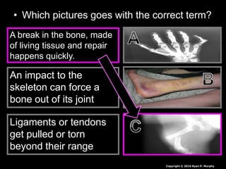 • Which pictures goes with the correct term?
A break in the bone, made
of living tissue and repair
happens quickly.
An impact to the
skeleton can force a
bone out of its joint
Ligaments or tendons
get pulled or torn
beyond their range
Copyright © 2010 Ryan P. Murphy
 