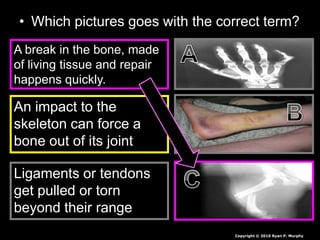 • Which pictures goes with the correct term?
A break in the bone, made
of living tissue and repair
happens quickly.
An impact to the
skeleton can force a
bone out of its joint
Ligaments or tendons
get pulled or torn
beyond their range
Copyright © 2010 Ryan P. Murphy
 