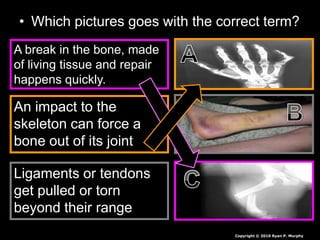 • Which pictures goes with the correct term?
A break in the bone, made
of living tissue and repair
happens quickly.
An impact to the
skeleton can force a
bone out of its joint
Ligaments or tendons
get pulled or torn
beyond their range
Copyright © 2010 Ryan P. Murphy
 