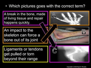 • Which pictures goes with the correct term?
A break in the bone, made
of living tissue and repair
happens quickly.
An impact to the
skeleton can force a
bone out of its joint
Ligaments or tendons
get pulled or torn
beyond their range
Copyright © 2010 Ryan P. Murphy
 