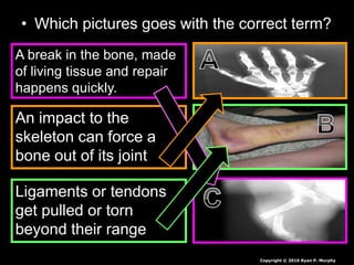 • Which pictures goes with the correct term?
A break in the bone, made
of living tissue and repair
happens quickly.
An impact to the
skeleton can force a
bone out of its joint
Ligaments or tendons
get pulled or torn
beyond their range
Copyright © 2010 Ryan P. Murphy
 