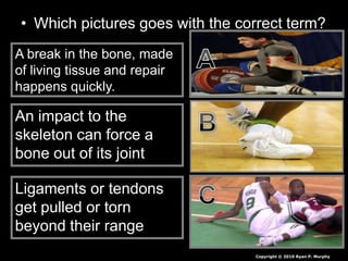 • Which pictures goes with the correct term?
A break in the bone, made
of living tissue and repair
happens quickly.
An impact to the
skeleton can force a
bone out of its joint
Ligaments or tendons
get pulled or torn
beyond their range
Copyright © 2010 Ryan P. Murphy
 