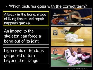• Which pictures goes with the correct term?
A break in the bone, made
of living tissue and repair
happens quickly.
An impact to the
skeleton can force a
bone out of its joint
Ligaments or tendons
get pulled or torn
beyond their range
Copyright © 2010 Ryan P. Murphy
 