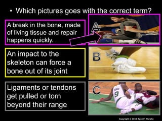 • Which pictures goes with the correct term?
A break in the bone, made
of living tissue and repair
happens quickly.
An impact to the
skeleton can force a
bone out of its joint
Ligaments or tendons
get pulled or torn
beyond their range
Copyright © 2010 Ryan P. Murphy
 