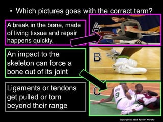 • Which pictures goes with the correct term?
A break in the bone, made
of living tissue and repair
happens quickly.
An impact to the
skeleton can force a
bone out of its joint
Ligaments or tendons
get pulled or torn
beyond their range
Copyright © 2010 Ryan P. Murphy
 