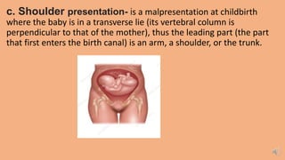 c. Shoulder presentation- is a malpresentation at childbirth
where the baby is in a transverse lie (its vertebral column is
perpendicular to that of the mother), thus the leading part (the part
that first enters the birth canal) is an arm, a shoulder, or the trunk.
 