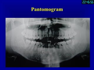 Part3.Extraction Of Teeth | PPT