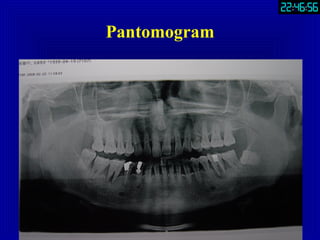 Part3.Extraction Of Teeth | PPT