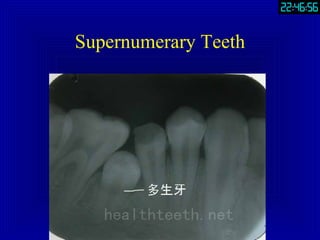 Supernumerary Teeth 