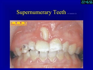 Supernumerary Teeth  #15. Indication  (2) 