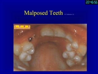 Part3.Extraction Of Teeth | PPT