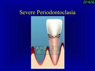 Severe Periodontoclasia 