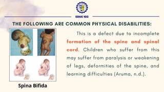This is a defect due to incomplete
formation of the spine and spinal
cord. Children who suffer from this
may suffer from paralysis or weakening
of legs, deformities of the spine, and
learning difficulties (Aruma, n.d.).
EDUC 103
THE FOLLOWING ARE COMMON PHYSICAL DISABILITIES:
Spina Bifida
 