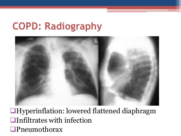 ECI COPD Course Lecture 3