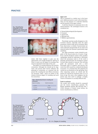 PRACTICE
564 BRITISH DENTAL JOURNAL VOLUME 195 NO. 10 NOVEMBER 22 2003
molar. Add these together to give you the
approximate arch length (length B). Subtract B
from A to give you the degree of crowding. This
must be repeated for both sides of the arch.
The degree of crowing influences the need for
extractions. Although one should not be dog-
matic and several other factors influence the
planning of extractions, as a general rule the
greater the crowding the more likely extractions
are necessary. Table 1 gives an outline of the
relation between degree of crowding and need
for extractions.
Upper arch
This is examined in a similar way to the lower
arch. Additional points to note in the mixed den-
tition are the presence of a mid-line diastema
and the position of the upper canines.
A mid-line diastema is commonly seen in the
mixed dentition. The aetiological factors to be
considered are:
• Normal (physiological) development
• Fraenum
• Small teeth
• Missing teeth
• Midline supernumerary
Physiologic spacing usually disappears as the
occlusion matures, especially when the upper
permanent canines erupt and no treatment apart
from observation is needed. Fraenectomies are
rarely indicated and generally do not need to be
removed unless the fraenum is particularly large
and fleshy.
The upper permanent canine should be pal-
pable in the buccal sulcus by 10 years of age.
If not, and the deciduous canine is firm, parallax
radiography should be undertaken to determine
where the permanent tooth is. If the tooth is
palatally positioned then the deciduous canines
on both sides should be removed. This will help
guide the permanent tooth into a more
favourable path of eruption and prevent any
centre line shift caused by a unilateral deciduous
extraction. It is essential that this palpation be
carried out on all patients in this age group. Very
often impacting canines are missed and the
patient not referred for treatment until 15 or 16
years of age. Not only is this negligent, but the
patient may then need to undergo a lengthy
course of treatment at a socially difficult time.
Teeth in occlusion
The overjet and overbite should be measured
and the incisor classification assessed. The
British Standards Institute (BS EN21942 Part 1
(1992) Glossary of Dental terms) defines the
incisor classification as follows:
Fig. 1 Decalcification
attributable to fixed
appliances and a patient with
poor oral hygiene throughout
treatment
Fig. 2 This patient has
a reasonable need for
orthodontic treatment,
but the poor oral hygiene
and gingival condition
precludes this
Table 1 Relationship between crowding and
extractions
Degree of crowding Need for extractions
< 5 mm No
5–10 mm Possibly
> 10 mm Yes
1+2+3+4+5 =A 1+2 = B
1
2
B – A = Degree of crowding
Fig. 3 Assessment of
crowding. The widths of
all the teeth anterior to
the molars are measured
and subtracted from the
sum of two measurements
(mesial of the lower
incisor to the distal of the
lower canine, plus distal
of lower canine to the
mesial of the first molar)
to give the degree of
crowding
 