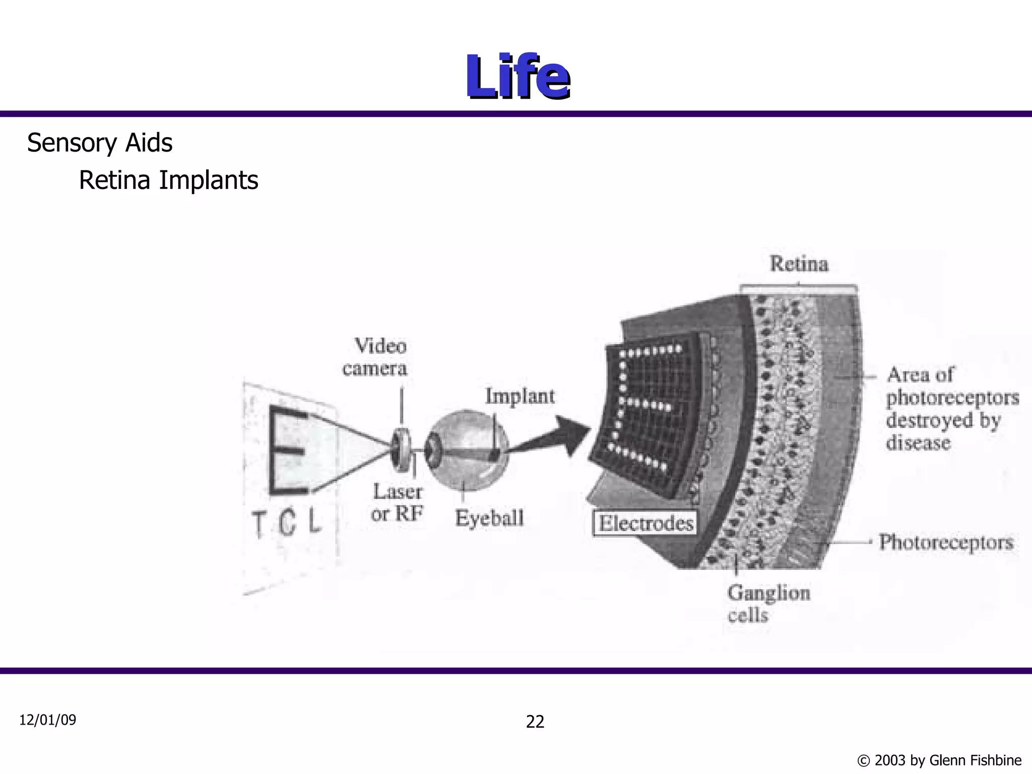 Life Sensory Aids Retina Implants 