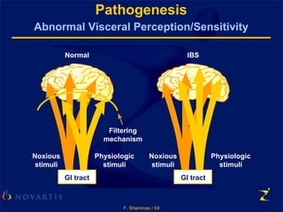 F. Shammas / 04
Pathogenesis
Abnormal Visceral Perception/Sensitivity
Physiologic
stimuli
Noxious
stimuli
IBS
Physiologic
stimuli
Filtering
mechanism
Noxious
stimuli
Normal
GI tractGI tract
 