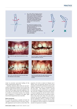PRACTICE
BRITISH DENTAL JOURNAL VOLUME 196 NO. 1 JANUARY 10 2004 11
result in excessive non-axial loading of the
tooth as illustrated in Figure 3b.
Overbite reduction when teeth are over pro-
clined is illustrated in Figures 4a–d. In this case
both the upper lateral incisors were pushed over
the bite with an upper removable appliance. The
cross bite was corrected but note the reduction
in overbite on the lateral incisors. Six months
after completion of treatment the upper right
lateral had relapsed back into cross bite.
Block movements
If a cross bite involves a number of teeth, for
example a unilateral buccal cross bite, remov-
able appliances can be used to correct this. The
sequence of events is shown in Figures 5a–f.
Adams cribs are generally placed on the first
premolars and the first permanent molars and a
midline expansion screw is incorporated into
the base plate. This midline screw is opened
0.25 mm (one quarter turn) twice a week until
the cross bite is slightly overcorrected. Posteri-
or buccal capping can also be used to disen-
gage the bite and prevent concomitant expan-
sion of the lower arch. Once the cross bite is
corrected the buccal capping can be removed
and the appliance used as a retainer to allow
the buccal occlusion to settle in. Occasionally
two appliances will be needed if a considerable
amount of expansion is needed.
Fig. 3a The effect of tipping anterior
teeth on the overbite. As the teeth
move around a centre of rotation the
incisal tip moves along the arc of a
circle. By the laws of geometry, as
the tooth is proclined the overbite
reduces once it moves past the
vertical
Fig. 3b Excessive tipping not only
reduces the overbite but also makes
the axial inclination of
the teeth too horizontal. In these
situations stability is reduced, the
appearance is poor and the tooth may
suffer from unwanted
non-axial loading ➠
➠
Fig. 4a Both the upper lateral incisors are in cross
bite
Fig. 4c The cross bites have been corrected. Note
the reduction in the overbite
Fig. 4d 6 months later the upper right lateral has
relapsed into cross bite due to the reduced
overbite
Fig. 4b An upper removable appliance was used to
tip the laterals over the bite
01p9-18.qxd 04/12/2003 14:31 Page 11
 