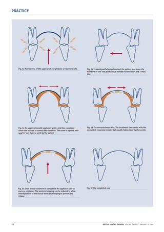PRACTICE
12 BRITISH DENTAL JOURNAL VOLUME 196 NO. 1 JANUARY 10 2004
Fig. 5a Narrowness of the upper arch can produce a traumatic bite
Fig. 5c An upper removable appliance with a mid line expansion
screw can be used to correct the cross bite. The screw is opened one-
quarter turn twice a week by the patient
Fig. 5d The corrected cross bite. The treatment time varies with the
amount of expansion needed but usually takes about twelve weeks
Fig. 5b To avoid painful cuspal contact the patient may move the
mandible to one side producing a mandibular deviation and a cross
bite
Fig. 5e Once active treatment is completed the appliance can be
worn as a retainer. The posterior capping can be reduced to allow
interdigitation of the buccal teeth thus helping to prevent any
relapse
Fig. 5f The completed case
01p9-18.qxd 04/12/2003 14:31 Page 12
 