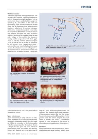 PRACTICE
BRITISH DENTAL JOURNAL VOLUME 196 NO. 1 JANUARY 10 2004 13
Overbite reduction
Removable appliances are very effective in cor-
recting a deep overbite, especially in a growing
patient. An upper removable appliance with an
anterior bite plane is used which disengages the
molars by 2–3 mm whilst at the same time
establishing lower incisor contact with the bite
plane (Fig. 6). Eruption of the posterior teeth
produces a reduction in the overbite. It is essen-
tial that the inter-incisor angle is corrected at
the completion of treatment so that an occlusal
stop between the upper and lower incisors is
produced preventing re-eruption of the incisors
and a relapse of the overbite. Bite planes are
usually used in conjunction with fixed appli-
ances to help the overbite reduction (Figures
7a–d) or can be used as an aid to restoration
of the anterior teeth. Figures 8a–d show a
patient with a deep bite who had marked enamel
erosion. Porcelain crowns were to be placed on
the anterior teeth to restore them, but the deep
bite made this technically difficult. The overbite
was therefore reduced with a bite plane to make
room for the crowns.
Space maintenance
Space maintainers are rarely indicated in ortho-
dontic treatment but occasionally can be used,
particularly if the upper canine is buccally crowd-
ed. Whilst the extraction of the first premolars
will often create space for the canines, there is
a danger that the space will close before the
canine erupts as the buccal teeth drift mesially.
Figures 9a–e illustrate such a case where the fit-
ting of a space maintainer proved useful. The
appliance was fitted just prior to the emergence
of the permanent canines. The four first premo-
lars were then extracted and the appliance left in
position until the canines erupted. This took
about 6 months and saved a considerable
amount of extra treatment for the patient by
allowing spontaneous alignment of the canines.
Retention
Many orthodontists use various types of remov-
able appliances to act as retainers, usually at the
2-3mm
Fig. 6 Overbite correction with a removable appliance. The posterior teeth
should be separated by about 2–3 mm
Fig. 7a A case with a deep bite and retroclined
upper incisors
Fig. 7c Once the overbite is fully reduced the
upper fixed appliance can be placed
Fig. 7d The completed case with good overbite
reduction
Fig. 7b An upper removable appliance is used to
help the overbite reduction whilst palatal springs
simultaneously move the first permanent
molars distally
01p9-18.qxd 04/12/2003 14:33 Page 13
 