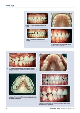 PRACTICE
14 BRITISH DENTAL JOURNAL VOLUME 196 NO. 1 JANUARY 10 2004
Fig. 8a, b A patient with severe erosion of the
teeth
Fig. 8c A bite plane was used to reduce the
overbite
Fig. 8d Strip crowns were placed on the incisors
once the overbite was reduced
Fig. 9a, b A case with severe upper arch crowding. The upper
permanent canines were unerupted, buccally positioned and
very short of space
Fig. 9c An upper removable space maintainer. Adam cribs have
been placed on the first permanent molars and a Southend clasp
on the upper central incisors
Fig. 9d,e The first premolars have been extracted and the upper canines
are erupting into a good position
➠
➠
➠ ➠
01p9-18.qxd 04/12/2003 14:34 Page 14
 