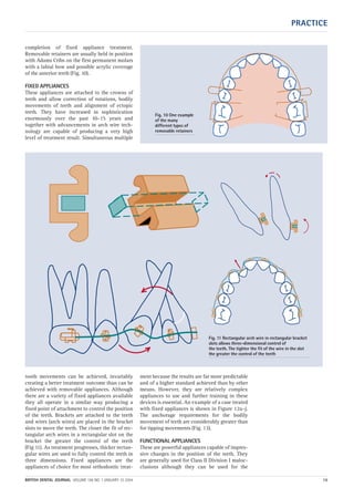 PRACTICE
BRITISH DENTAL JOURNAL VOLUME 196 NO. 1 JANUARY 10 2004 15
completion of fixed appliance treatment.
Removable retainers are usually held in position
with Adams Cribs on the first permanent molars
with a labial bow and possible acrylic coverage
of the anterior teeth (Fig. 10).
FIXED APPLIANCES
These appliances are attached to the crowns of
teeth and allow correction of rotations, bodily
movements of teeth and alignment of ectopic
teeth. They have increased in sophistication
enormously over the past 10–15 years and
together with advancements in arch wire tech-
nology are capable of producing a very high
level of treatment result. Simultaneous multiple
tooth movements can be achieved, invariably
creating a better treatment outcome than can be
achieved with removable appliances. Although
there are a variety of fixed appliances available
they all operate in a similar way producing a
fixed point of attachment to control the position
of the teeth. Brackets are attached to the teeth
and wires (arch wires) are placed in the bracket
slots to move the teeth. The closer the fit of rec-
tangular arch wires in a rectangular slot on the
bracket the greater the control of the teeth
(Fig 11). As treatment progresses, thicker rectan-
gular wires are used to fully control the teeth in
three dimensions. Fixed appliances are the
appliances of choice for most orthodontic treat-
ment because the results are far more predictable
and of a higher standard achieved than by other
means. However, they are relatively complex
appliances to use and further training in these
devices is essential. An example of a case treated
with fixed appliances is shown in Figure 12a–j.
The anchorage requirements for the bodily
movement of teeth are considerably greater than
for tipping movements (Fig. 13).
FUNCTIONAL APPLIANCES
These are powerful appliances capable of impres-
sive changes in the position of the teeth. They
are generally used for Class II Division I maloc-
clusions although they can be used for the
Fig. 10 One example
of the many
different types of
removable retainers
Fig. 11 Rectangular arch wire in rectangular bracket
slots allows three-dimensional control of
the teeth. The tighter the fit of the wire in the slot
the greater the control of the teeth
01p9-18.qxd 04/12/2003 14:37 Page 15
 