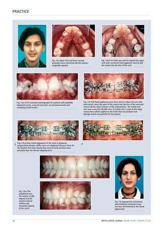 PRACTICE
16 BRITISH DENTAL JOURNAL VOLUME 196 NO. 1 JANUARY 10 2004
Fig. 12a, b Pre treatment photographs of a patient with palatally
impacted canine, a buccal cross bite, an increased overjet and
crowding in both arches
Fig. 12c Upper first and lower second
premolars were extracted and the canines
surgically exposed
Fig. 12d A tri-helix was used to expand the upper
arch and a sectional fixed appliance used to pull
the canine into the line of the arch
Fig. 12e Full fixed appliances were then used to reduce the over bite
and overjet, move the apex of the canine into the line of the arch and
correct all the other features of the malocclusion. The initial arch
wire was a very thin flexible wire. If a thick wire is used at this stage
excess force will be applied to the teeth that can produce root
damage and be very painful for the patient
Figs 12f,g Once initial alignment of the teeth is produced
progressively thicker, stiffer wires are employed. Because these fit
the bracket slot more closely they control tooth position more
precisely than the thinner aligning wires
Fig. 12h,i The
completed case.
The canine is fully
aligned and the
overjet reduced
without any
unwanted tipping
of the teeth
Fig. 12j Appropriate extractions
and treatment mechanics have
not been detrimental to the facial
appearance
➠
➠
01p9-18.qxd 04/12/2003 14:39 Page 16
 