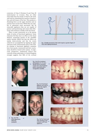 PRACTICE
BRITISH DENTAL JOURNAL VOLUME 196 NO. 1 JANUARY 10 2004 17
correction of Class II Division II and Class III
malocclusions on occasion. They are either
removable from the mouth or fixed to the teeth,
and work by stimulating the muscles of mastica-
tion and soft tissues of the face. This produces a
distalising force on the upper dentition and an
anterior force on the lower. Whilst they are capa-
ble of substantial tooth movement, like all
removable appliances they are not capable of
precise tooth positioning and cannot deal effec-
tively with rotations or bodily tooth movement.
There is some controversy as to the precise
mode of action of functional appliances. Some
clinicians feel they have an effect on this facial
skeleton, promoting growth of the mandible
and/or maxilla. Others feel that the effects are
mainly dento-alveolar and that the results
achieved are accomplished by tipping the upper
and lower teeth. Unfortunately many of the stud-
ies relating to functional appliance treatment
have been poorly constructed and their conclu-
sions should be treated with caution. A large-
scale, prospective, randomized clinical trial
currently being undertaken in United Kingdom
strongly suggests that 98% of the occlusal
Fig. 13 Bodily movement of the teeth requires a greater degree of
force than tipping movements
Fig. 14c A functional
appliance was used to
correct the saggital
relationship
Fig. 14d The final result
after detailing of the
occlusion with fixed
appliances
Fig. 14e,f The
facial appearance
following
treatment
Fig. 14a,b Pre-treatment
photographs of a 12-year-
old girl with an increased
overjet and a class II skeletal
pattern associated with a
retrognathic mandible
➠
➠
➠
➠
➠
➠
01p9-18.qxd 04/12/2003 14:41 Page 17
 