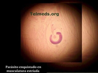 Parásito enquistado en musculatura estriada  