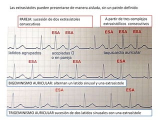 Arritmias Supraventriculares PPTX Arritmias Supraventriculares PPTX