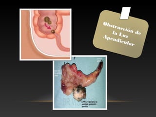 Obstrucción dela LuzApendicular
 