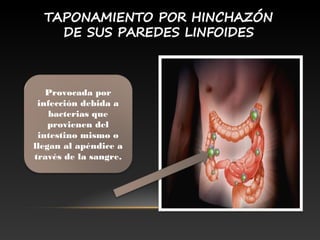Provocada por
infección debida a
bacterias que
provienen del
intestino mismo o
llegan al apéndice a
través de la sangre.
 
