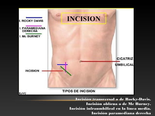 Incisión transversal o de Rocky-Davis.Incisión transversal o de Rocky-Davis.
Incisión oblícua o de Mc Burney.Incisión oblícua o de Mc Burney.
Incisión infraumbilical en la línea media.Incisión infraumbilical en la línea media.
Incisión paramediana derechaIncisión paramediana derecha..
 