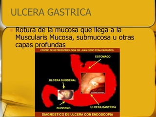 ULCERA GASTRICA
   Rotura de la mucosa que llega a la
    Muscularis Mucosa, submucosa u otras
    capas profundas
 