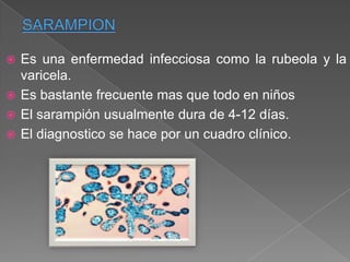 Es una enfermedad infecciosa como la rubeola y la
varicela.
 Es bastante frecuente mas que todo en niños
 El sarampión usualmente dura de 4-12 días.
 El diagnostico se hace por un cuadro clínico.


 