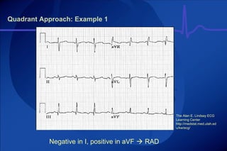 Rad Ecg Example Part ecg stemi nstemi 2019 | PPT