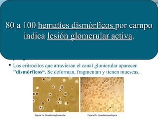 Análisis del Sedimento Urinario
80 a 100 hematíes dismórficos por campo 
             ¿Qué se puede observar?
       indic...