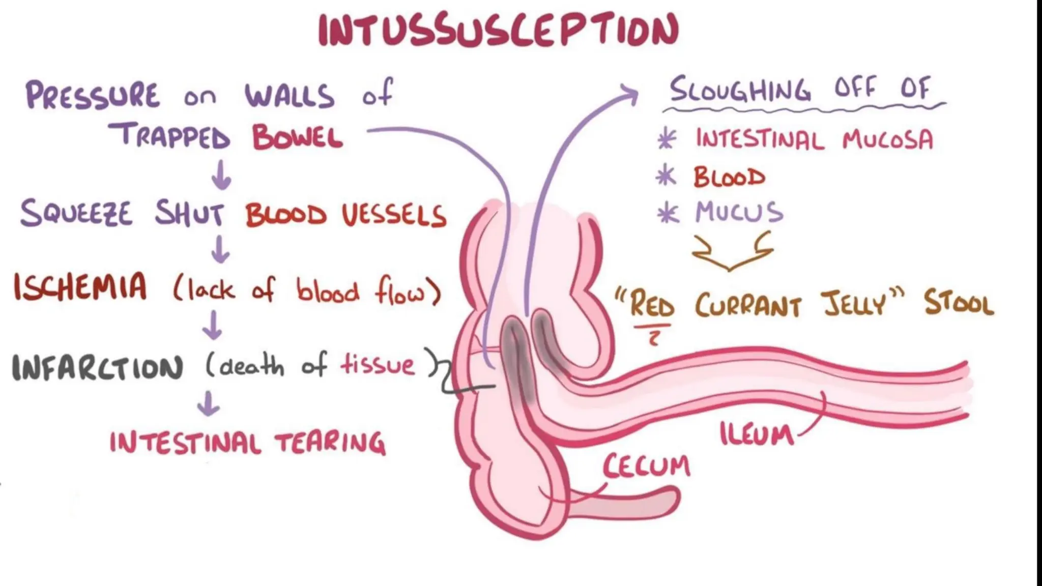 Partial Intestinal Obstruction