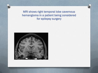 MRI shows right temporal lobe cavernous
hemangioma in a patient being considered
for epilepsy surgery
 