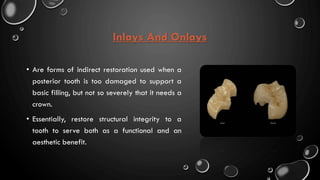 Inlays And Onlays
• Are forms of indirect restoration used when a
posterior tooth is too damaged to support a
basic filling, but not so severely that it needs a
crown.
• Essentially, restore structural integrity to a
tooth to serve both as a functional and an
aesthetic benefit.
 