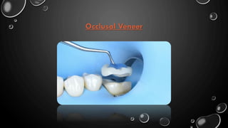 Occlusal Veneer
 