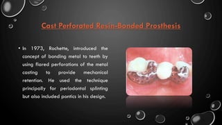 Cast Perforated Resin-Bonded Prosthesis
• In 1973, Rochette, introduced the
concept of bonding metal to teeth by
using flared perforations of the metal
casting to provide mechanical
retention. He used the technique
principally for periodontal splinting
but also included pontics in his design.
 