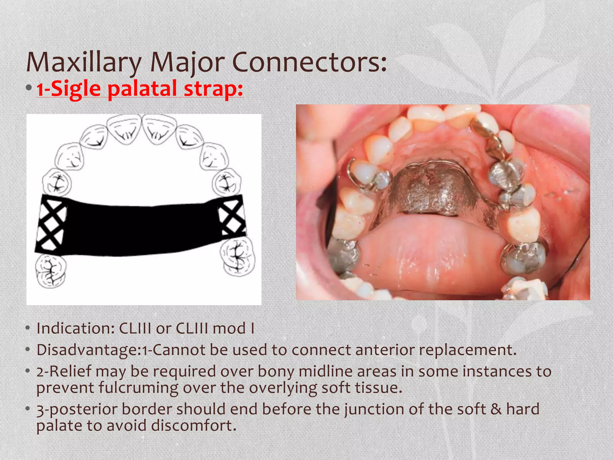 Palatable Strap Rpd removable Partial denture | PPTX
