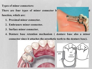 Lattice Rpd removable Partial denture | PPTX