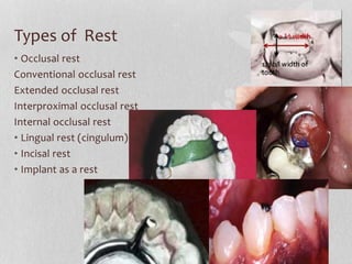 Interproximal Rest Rpd removable Partial denture | PPTX
