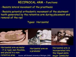 Partial dentures | PPT