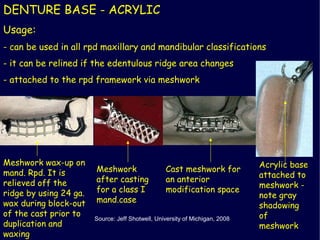Mand Rpd Partial dentures | PPT