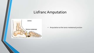 Lisfranc Amputation
• Amputation at the tarso-metatarsal junction
 