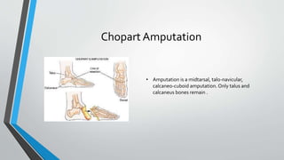 Chopart Amputation
• Amputation is a midtarsal, talo-navicular,
calcaneo-cuboid amputation. Only talus and
calcaneus bones remain .
 